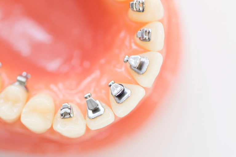 見えづらい矯正〜裏側(舌側)矯正〜 - 東京日本橋矯正歯科 医療法人社団